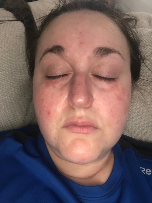 mild dermatitis herpetiformis on face